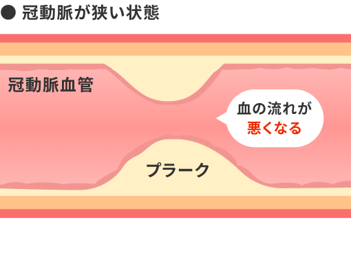 冠動脈が狭い状態