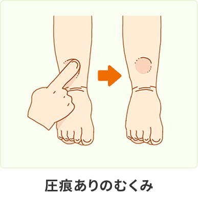 圧痕ありのむくみ