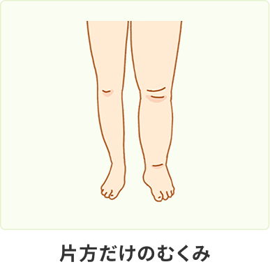 片方だけのむくみ