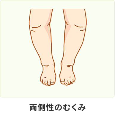 両側性のむくみ