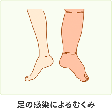 足の感染によるむくみ