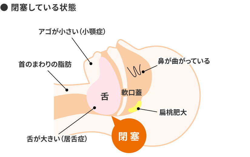 閉塞している状態